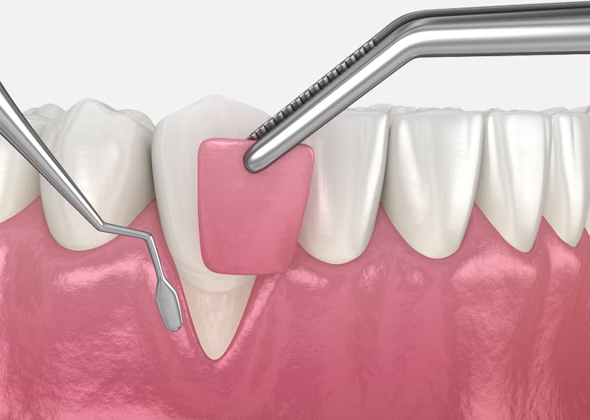 Chirurgia degli innesti gengivali in Turchia 1 Interventi di innesto gengivale in Turchia