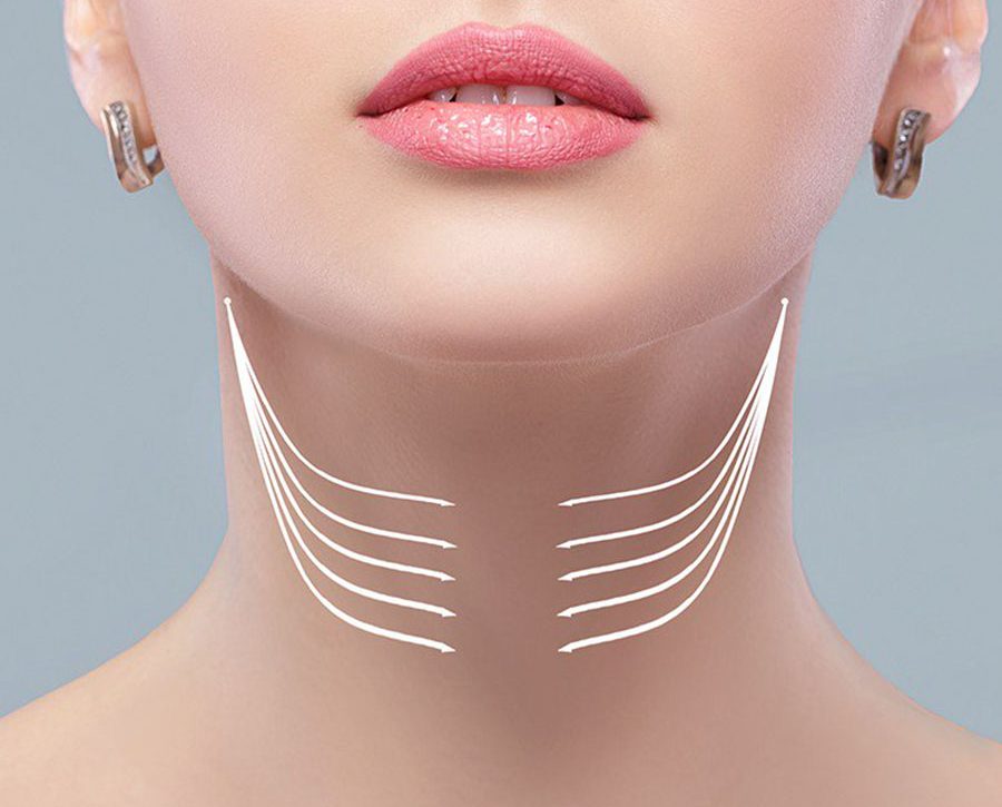 Lifting du cou en Turquie 1 Lifting-du-cou-en-Turquie