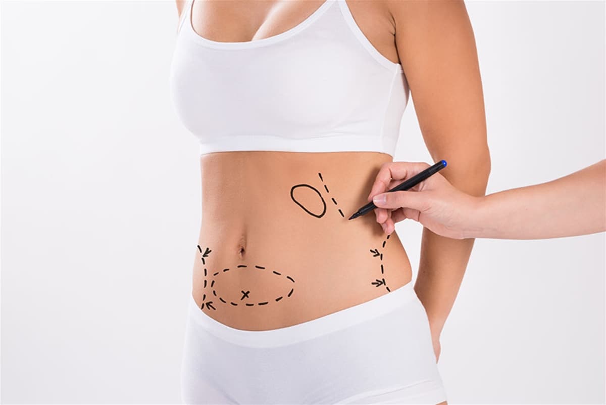Liposuction in Turkey 1 Lipo-in-Turkey