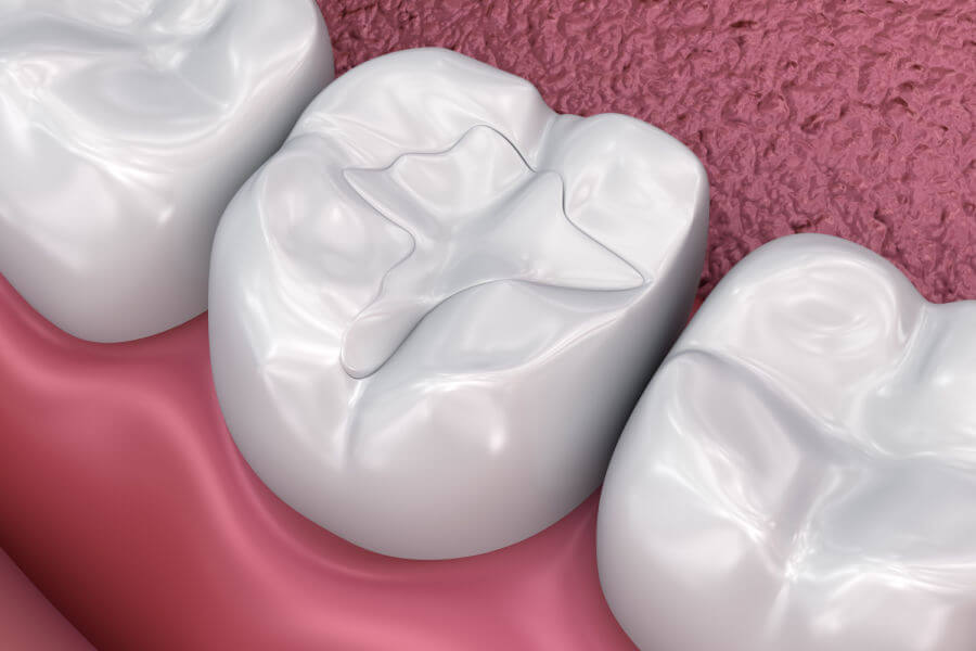 Otturazioni Dentali in Turchia 1 Otturazioni Dentali in Turchia