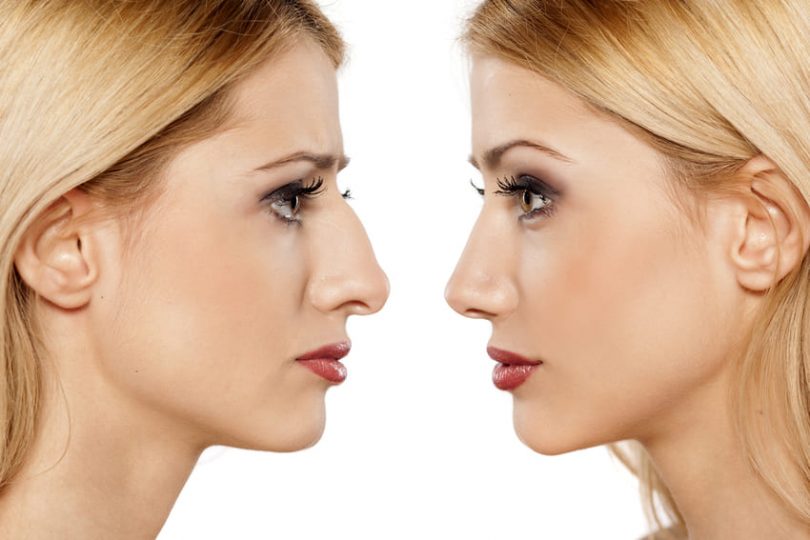 Rhinoplastie en Turquie 1 Rhinoplastie en Turquie