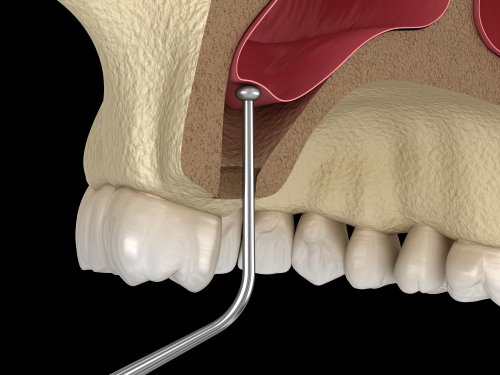 Sinus-Lifting-in-Turkey