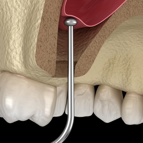 Sinus lift En Turquie