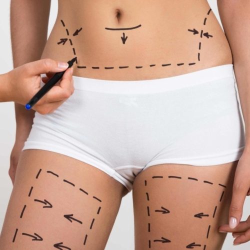 Vaser-Liposuction-Nedir.