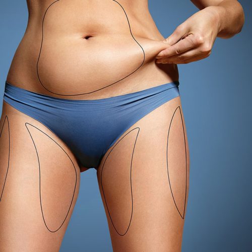 Vaser-Liposuction-Turkey