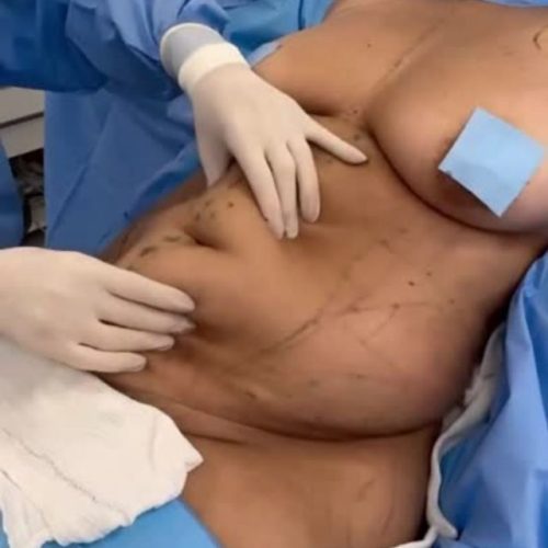 Tummy Tuck in Turkey