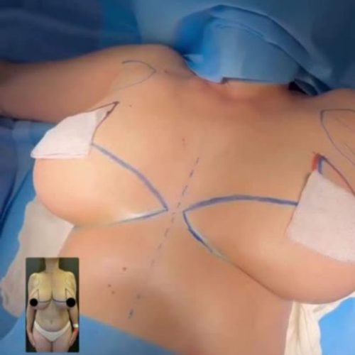 bbl-liposuction-in-turkey-before-after