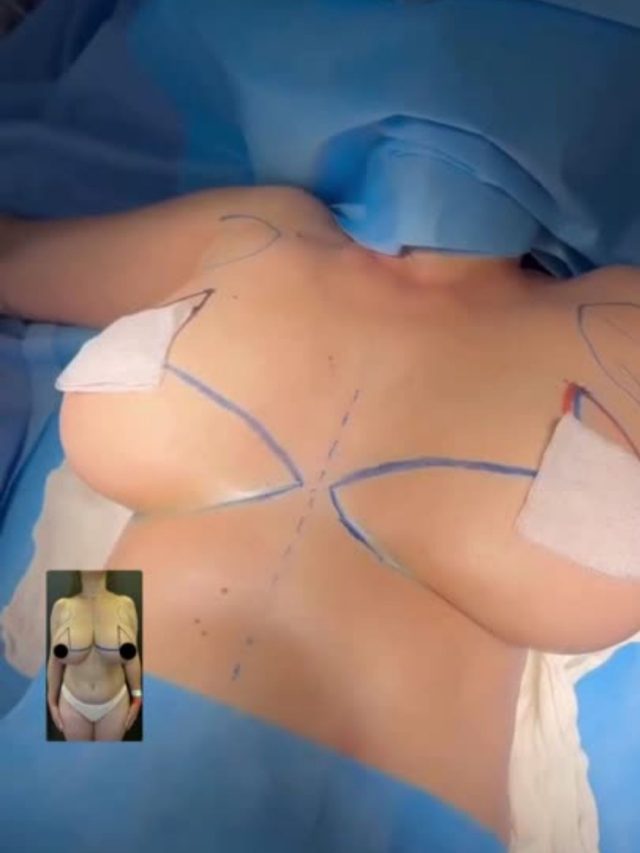 Breast Lift in Turkey: Stunning Before and After Transformations