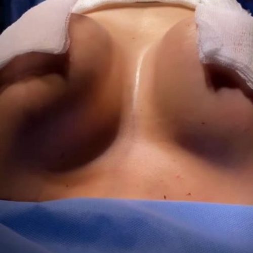 bbl-liposuction-in-turkey-before-after