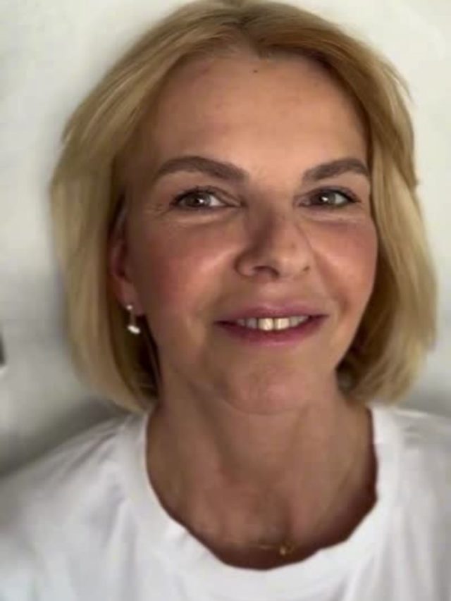 Facelift Before and After: The Secret to Rejuvenation