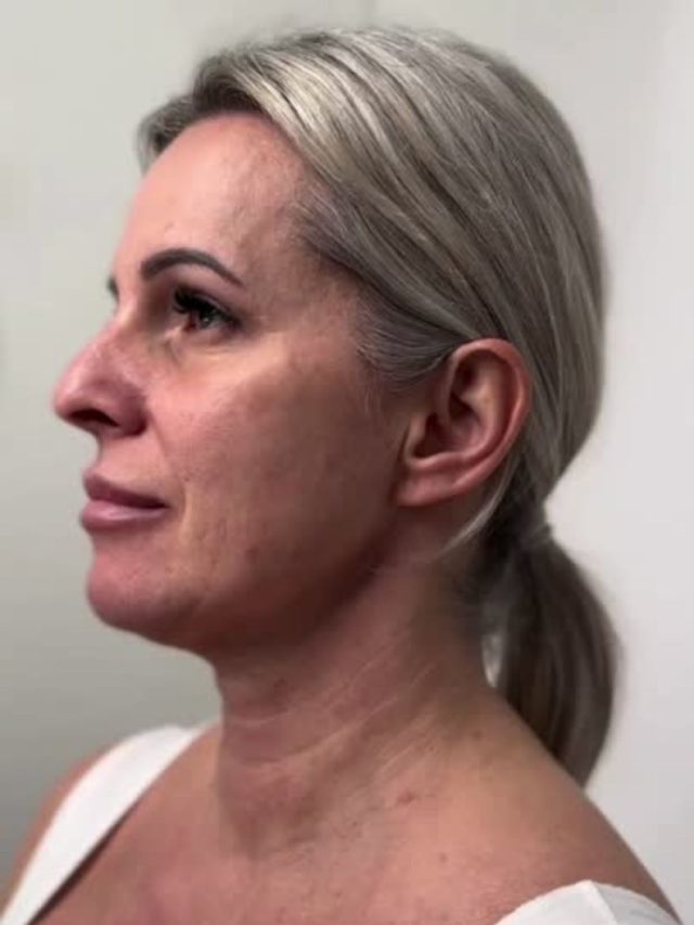 After Facelift Surgery: Meet the Renewed Face