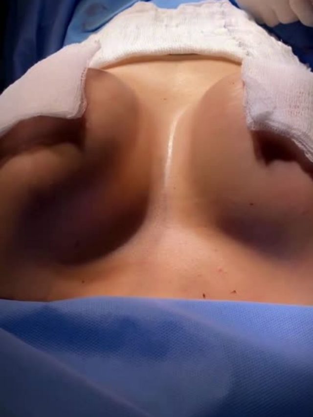 From Consultation to Transformation: Breast Augmentation Results in Turkey