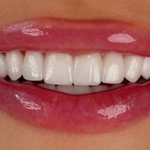 Zirconium Crowns in Turkey