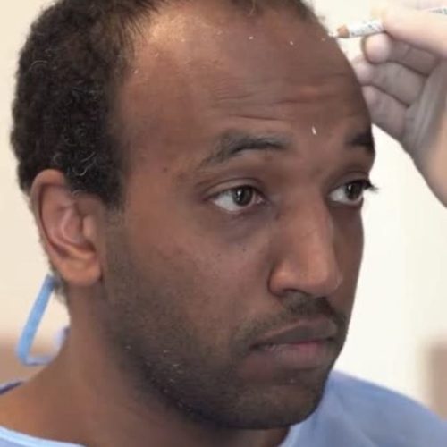 Afro Hair Transplant Turkey