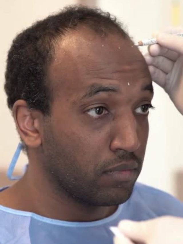 Afro Hair Transplants in Turkey: The Ultimate Guide to Your Perfect Curls