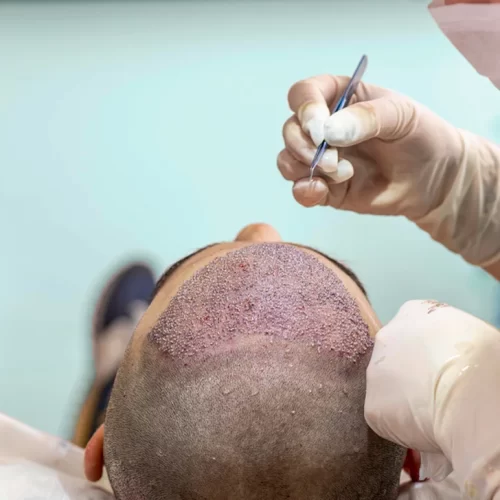 1500 Grafts Hair Transplant- What to Expect