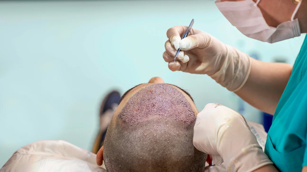 1500 Grafts Hair Transplant: What to Expect 1 1500 Grafts Hair Transplant- What to Expect