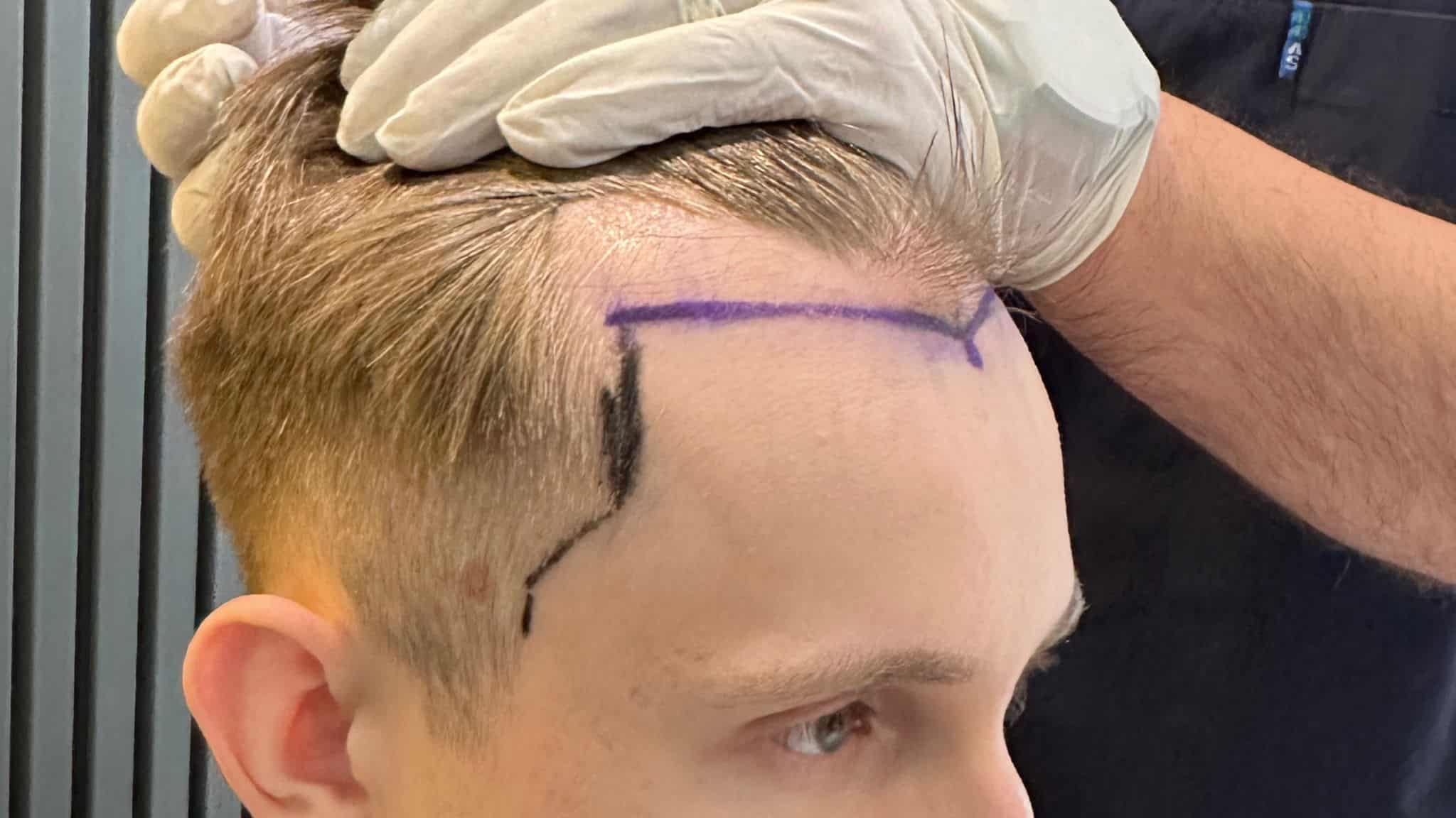 2500 Grafts Hair Transplant: What to Expect from This Procedure 1 2500 Grafts Hair Transplant: What to Expect from This Procedure