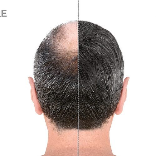 3000 Grafts Hair Transplant