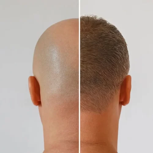 4000 Grafts Hair Transplant in Turkey