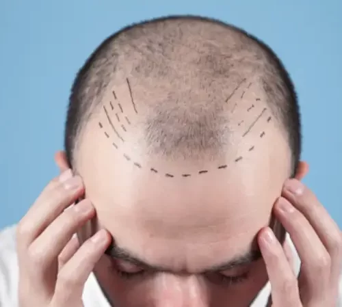 4500 Grafts Hair Transplant