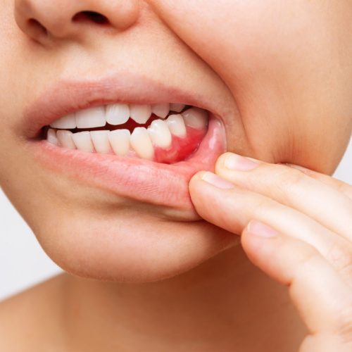 5 Receding Gums Stages to Watch Out For