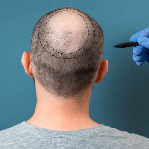 5000 Grafts Hair Transplant