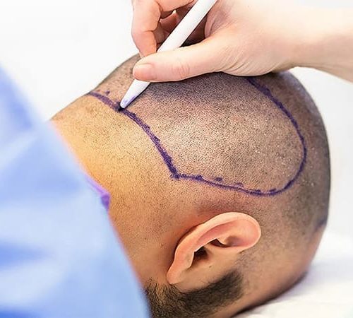 6000 Grafts Hair Transplant in Turkey: Everything You Need to Know