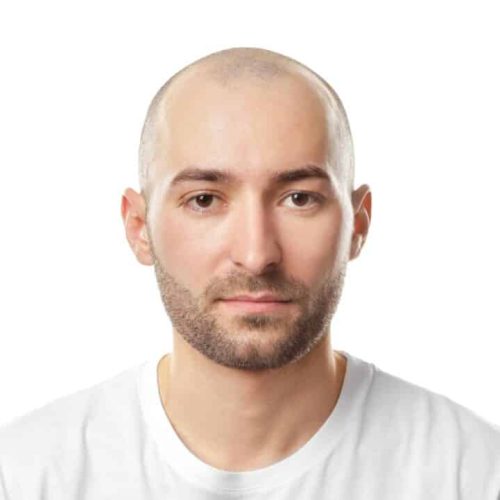 Am I Too Bald for a Hair Transplant? Everything You Need to Know