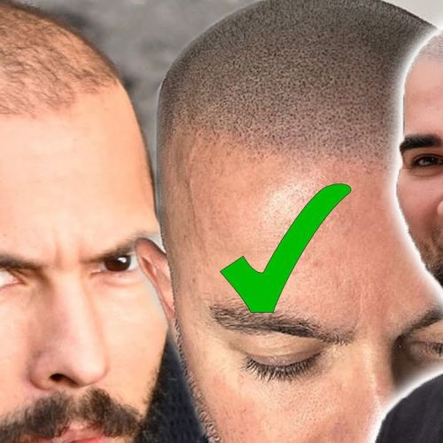 Andrew Tate Hair Transplant