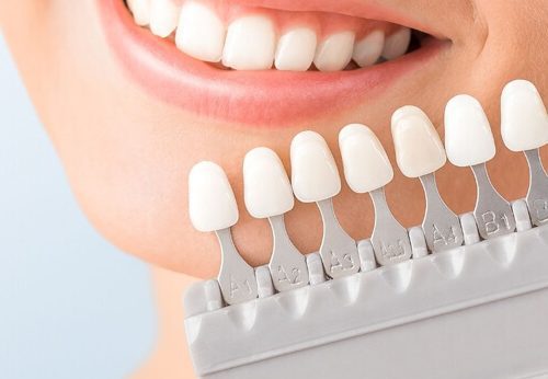 Are Yellow Teeth Stronger than White Teeth? Exploring the Myths and Facts