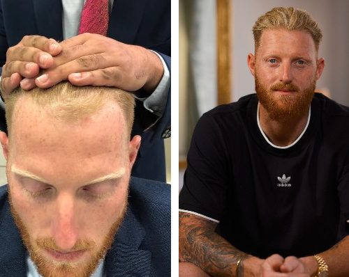 Ben Stokes Hair Transplant: A Game-Changing Transformation?