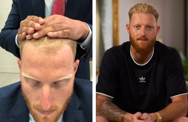 Ben Stokes Hair Transplant: A Game-Changing Transformation? 1 Ben Stokes Hair Transplant: A Game-Changing Transformation?