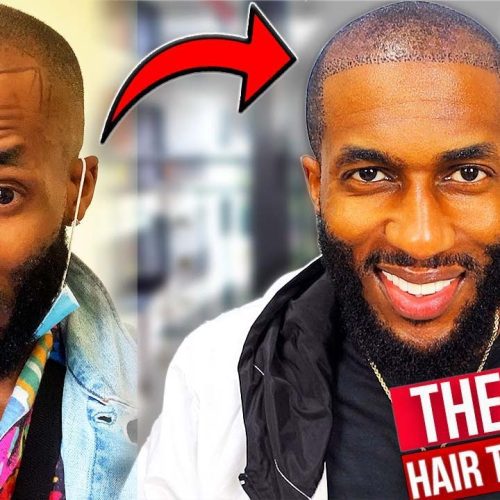 Black Celebrity Hair Transplants: Inspiring Transformations and Breaking Stigmas