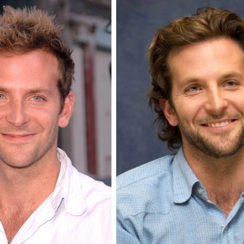 Bradley Cooper Hair Transplant