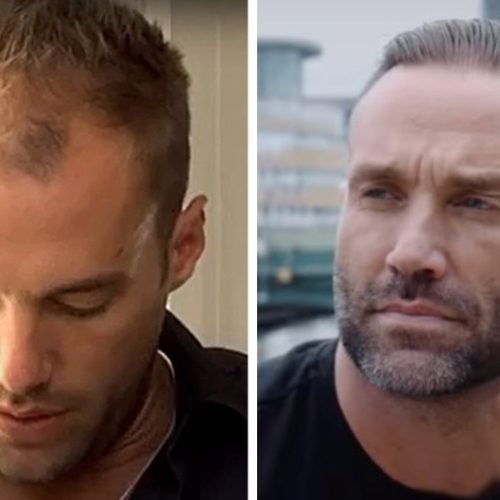 Calum Best Hair Transplant Journey: A Path to Confidence and Transformation