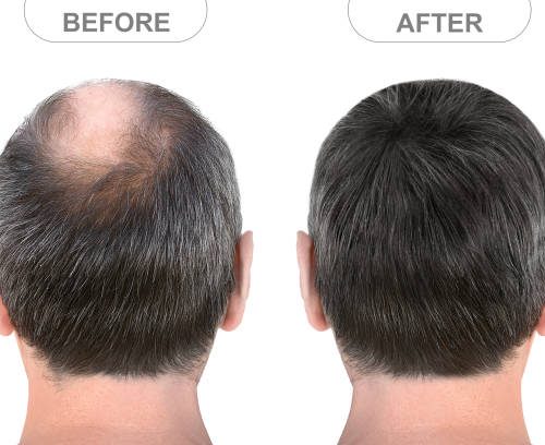 Can You Go Bald After a Hair Transplant? Understanding the Longevity of Hair Restoration