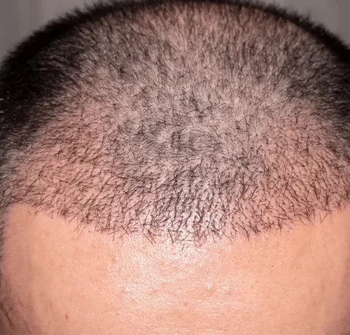 Can You Wear a Hat After a Hair Transplant? Tips for Protecting Your New Grafts