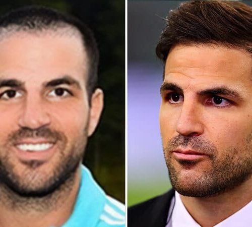 Cesc Fàbregas Hair Transplant: A Game-Changer for Confidence