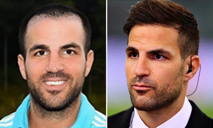 Cesc Fàbregas Hair Transplant: A Game-Changer for Confidence 1 Cesc Fàbregas Hair Transplant: A Game-Changer for Confidence