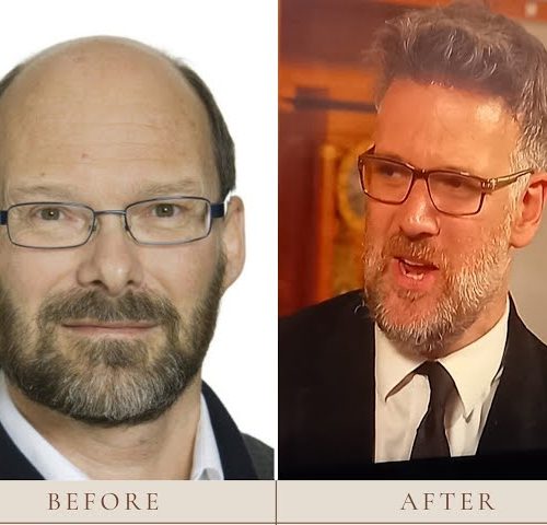 Charles Hanson Hair Transplant Journey: Restoring Confidence and Charm