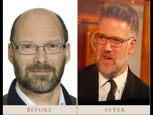Charles Hanson Hair Transplant Journey: Restoring Confidence and Charm 1 Charles Hanson Hair Transplant Journey: Restoring Confidence and Charm