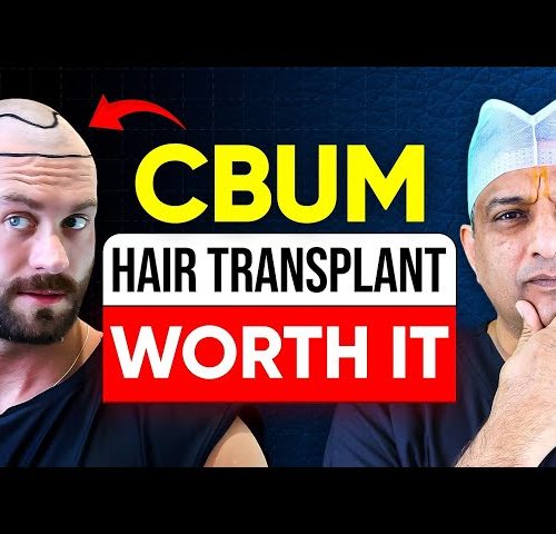 Chris Bumstead (CBum) Hair Transplant: Rumors, Reality, and the Journey to Confidence