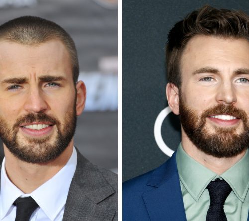 Chris Evans Hair Transplant: Did Captain America Restore His Hairline?