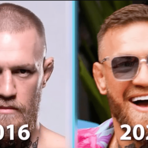 Conor McGregor Hair Transplant: A Closer Look at the MMA Star’s Hair Transformation