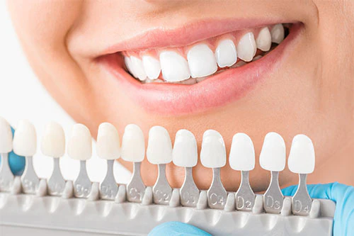 Cost Comparison of Full Mouth Veneers: Key Factors to Consider