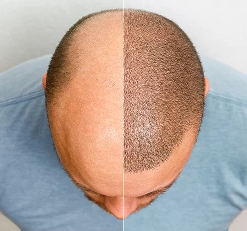 Crown Area Hair Transplant: Restoring Confidence and Coverage