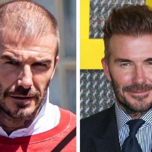 David Beckham Hair Transplant: Unveiling the Truth Behind His Hair Transformation