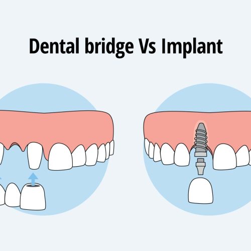 Dental Bridge vs. Dental Implant: Which Option Is Right for You?