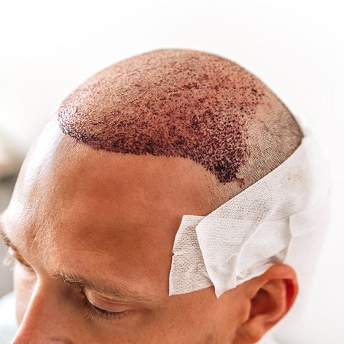 Do Hair Transplants Hurt? | Are They Painful?